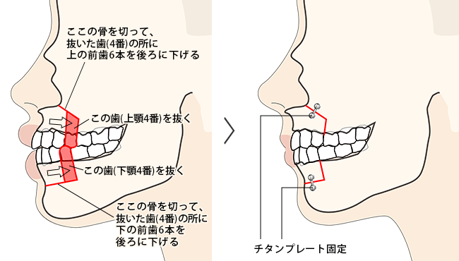 �㉺�Z�b�g�o�b�N